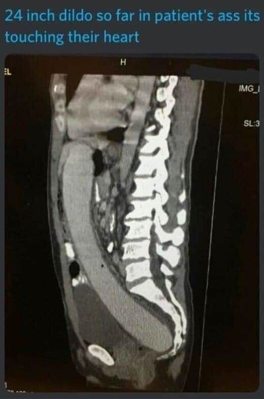 24인치 딜도가 안빠져서 병원온 사람