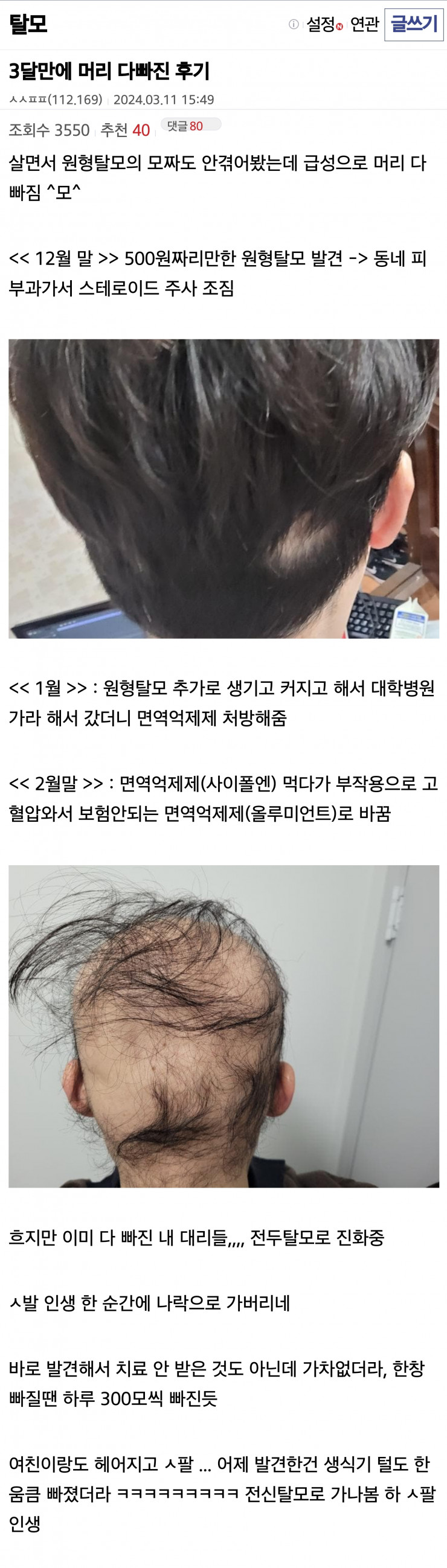 탈모 때문에 여친에게 차였다는 역대급 탈모갤러.jpg