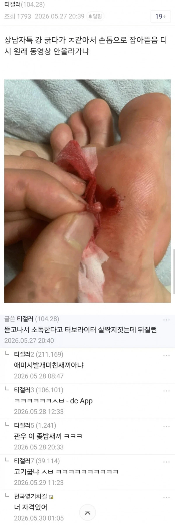 티눈..